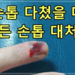 손톱 다쳤을 때, 피멍든 손톱 대처 방법