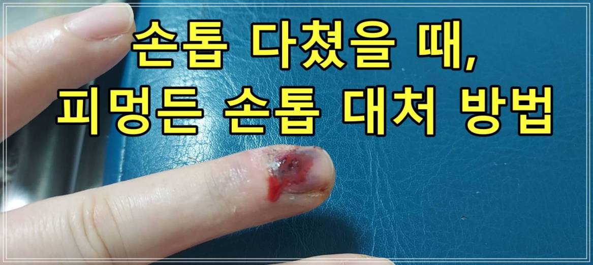 손톱 다쳤을 때, 피멍든 손톱 대처 방법