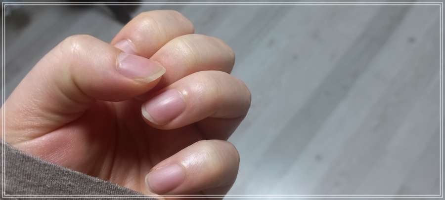 정상 손톱