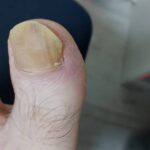 엄지 발톱. 무좀으로 노랗게 색이 변함