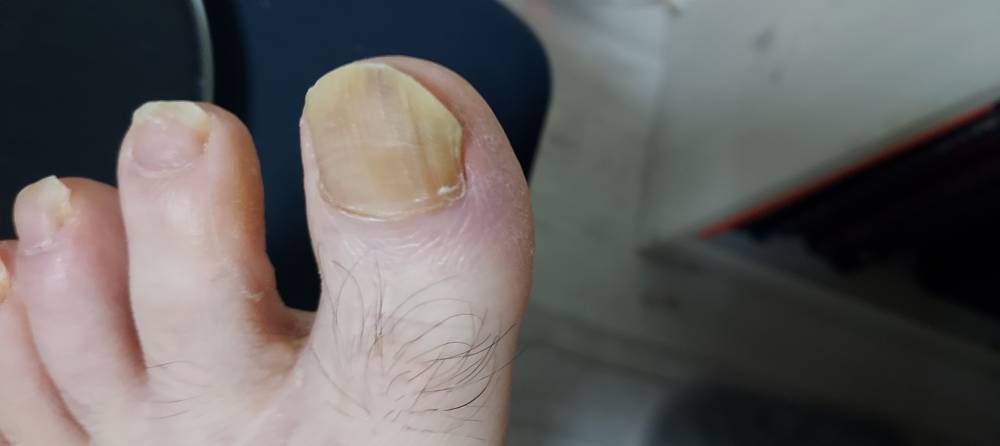엄지 발톱. 무좀으로 노랗게 색이 변함