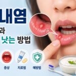구내염 걸리는 원인과 빨리 낫는 방법