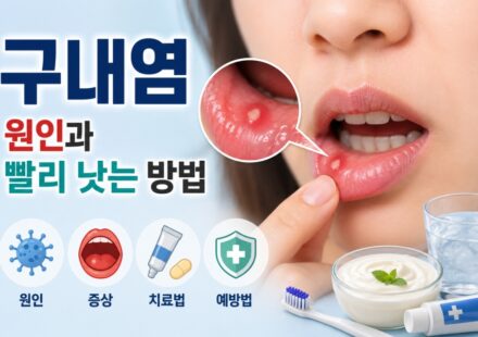 구내염 걸리는 원인과 빨리 낫는 방법